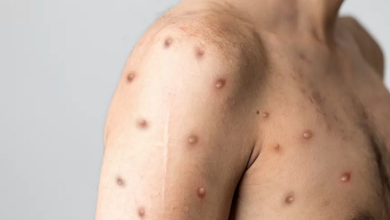 Foto da matéria Não há casos de varíola do macaco em pacientes de Umuarama, afirma secretário